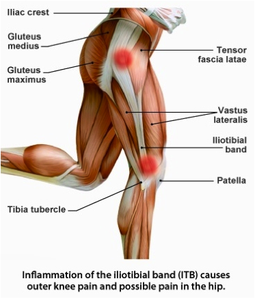 Iliotibial Band Syndrome – ITB (Runners Knee) - Motion Health Centre